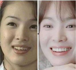 明星做烤瓷牙怎么做的,揭秘明星美丽微笑的秘密武器